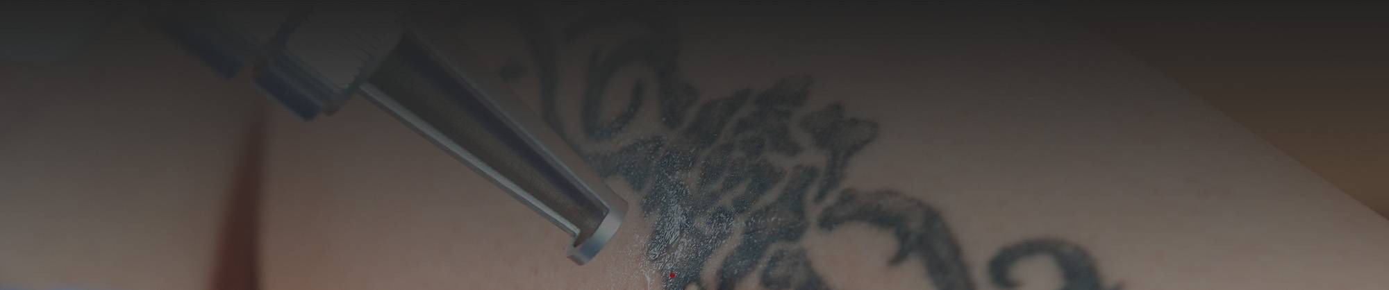 PicoSure Laser tattoo removal near Milwaukee