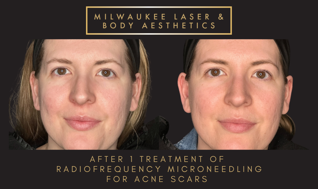 Severe Acne Scars - Customized Treatment Plan before and after image