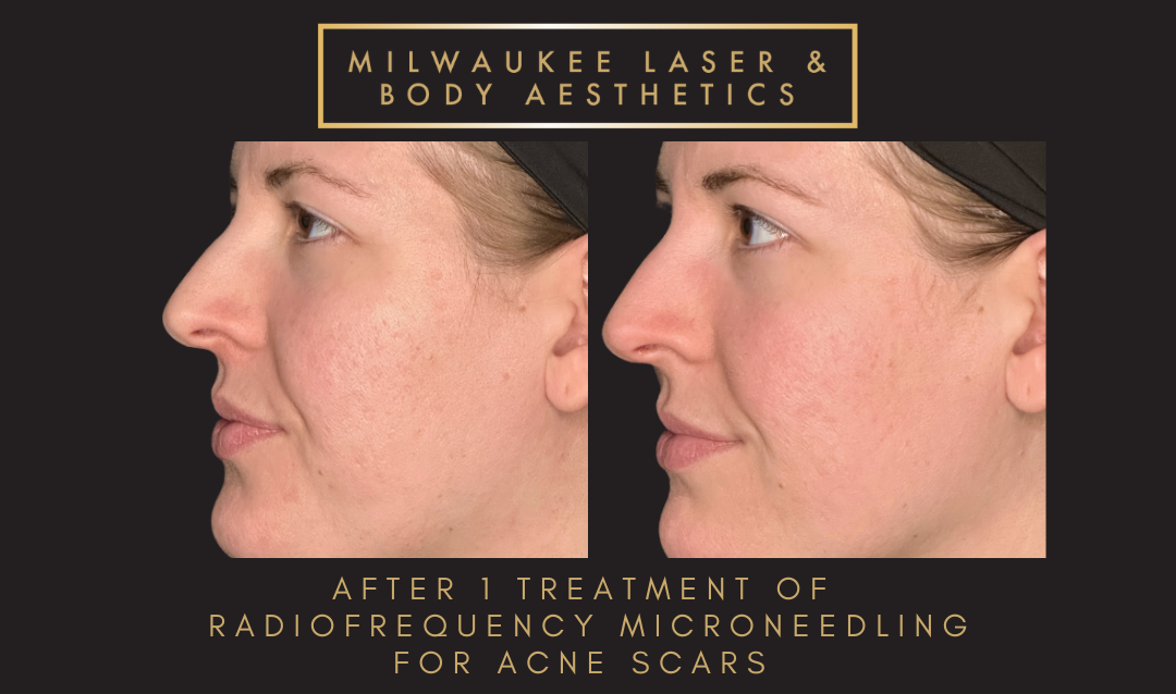 Severe Acne Scars - Customized Treatment Plan before and after image