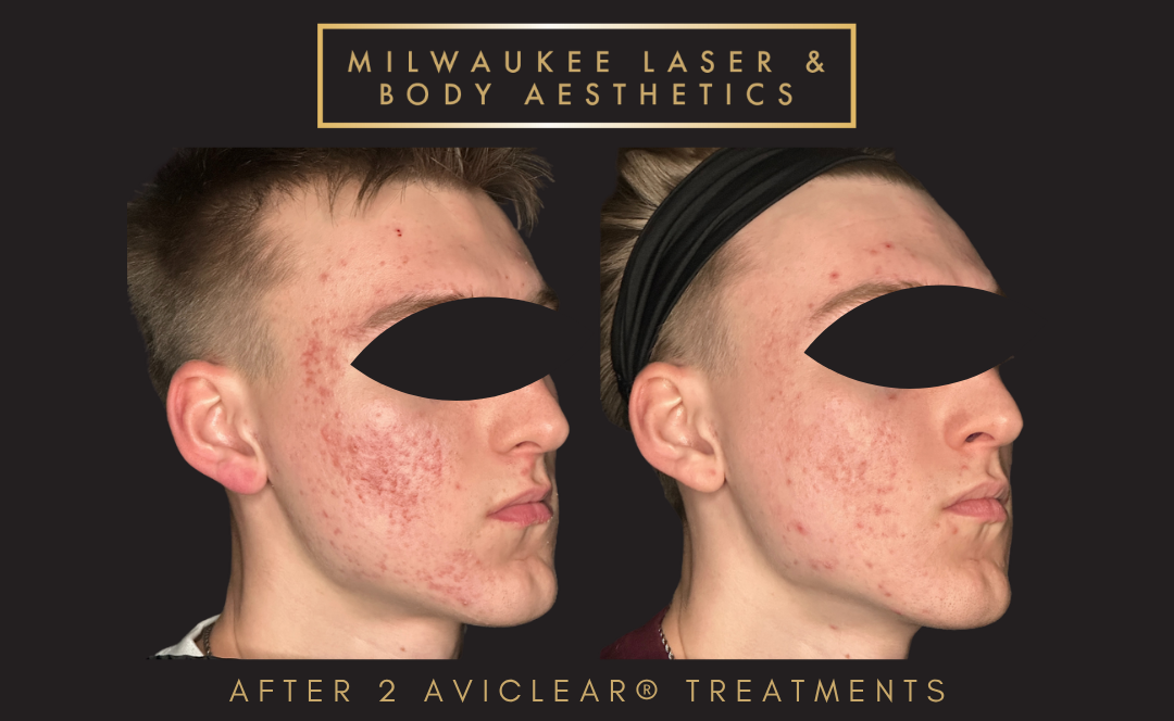 Severe Acne Scars - Customized Treatment Plan before and after image