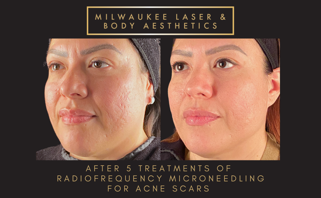 Severe Acne Scars - Customized Treatment Plan before and after image