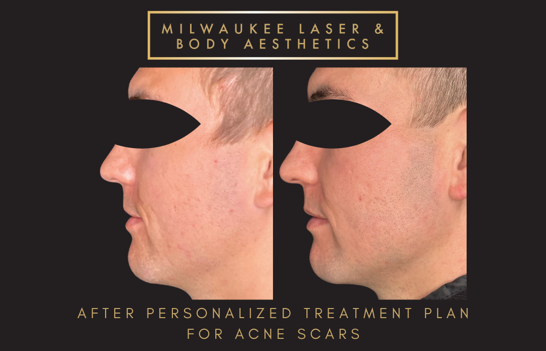 Acne - 2 Treatments before and after image