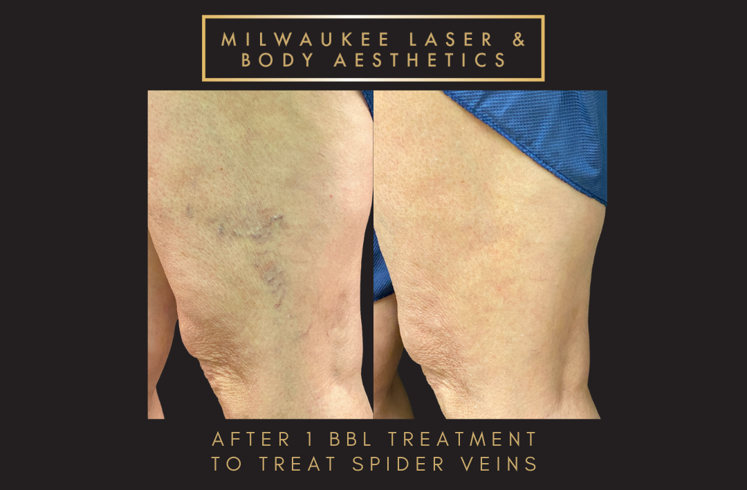 Mequon Vein Treatment Plan & 1 MLB Treatment before and after image