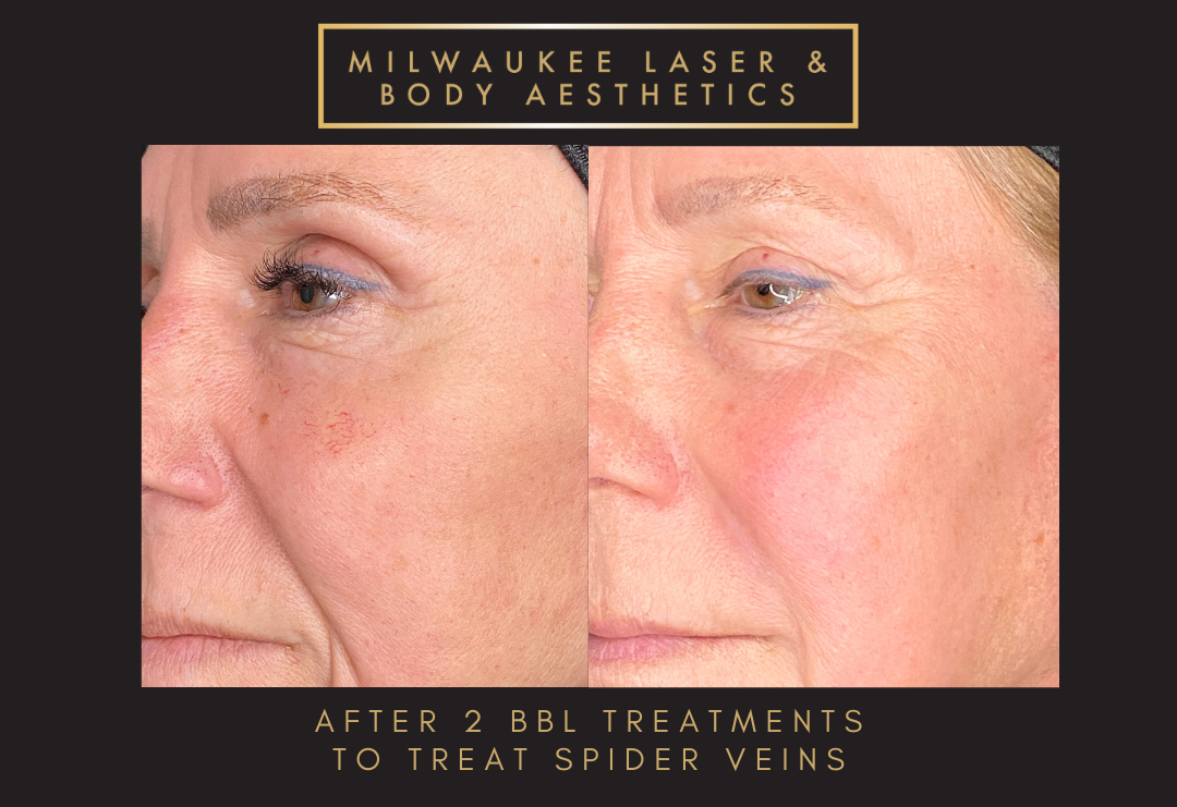 Reds / Spider Veins - 1 Treatment before and after image