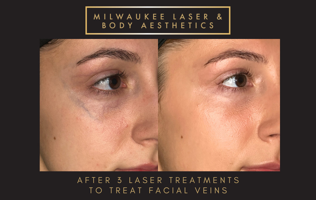 Mequon Vein Treatment Plan & 3 MLB Treatment before and after image
