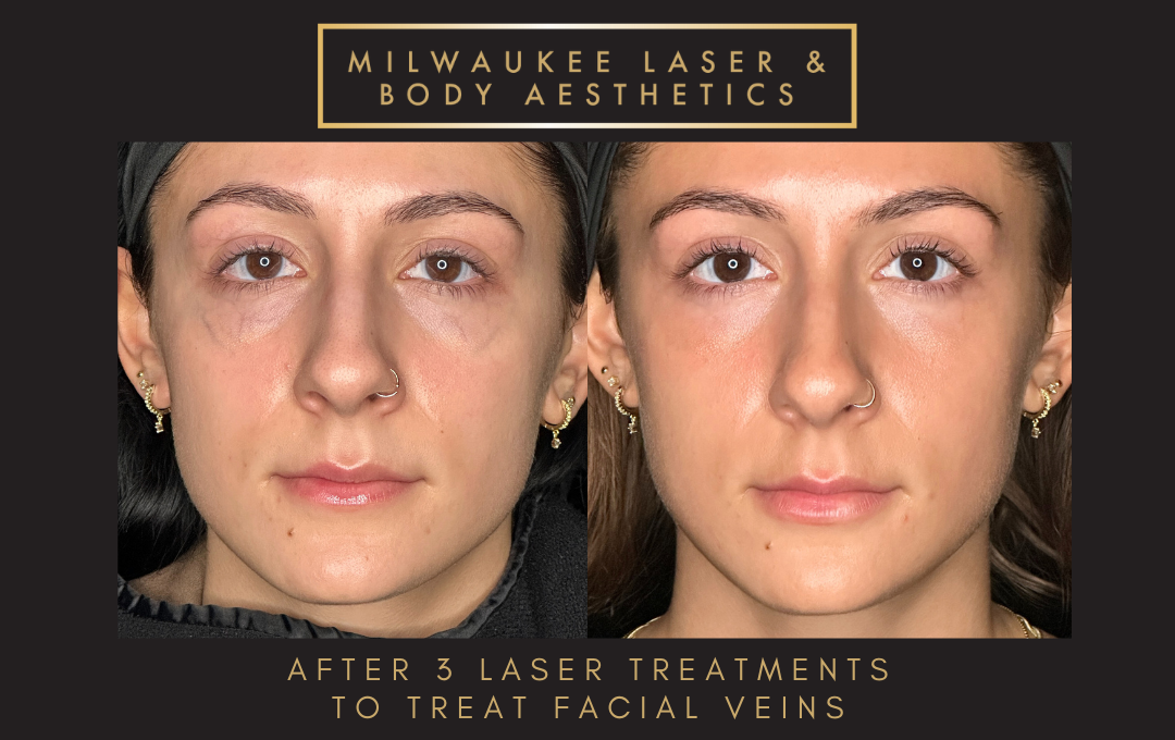 Mequon Vein Treatment Plan & 3 MLB Treatment before and after image