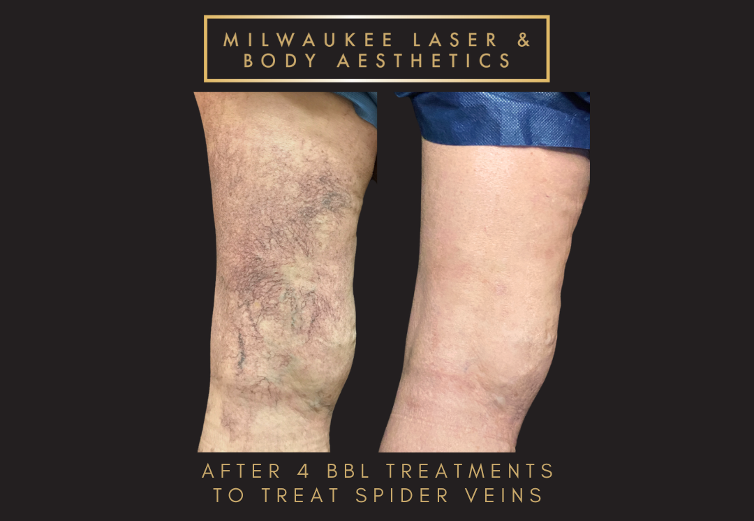 Mequon Vein Treatment Plan & 4 MLB Treatments before and after image