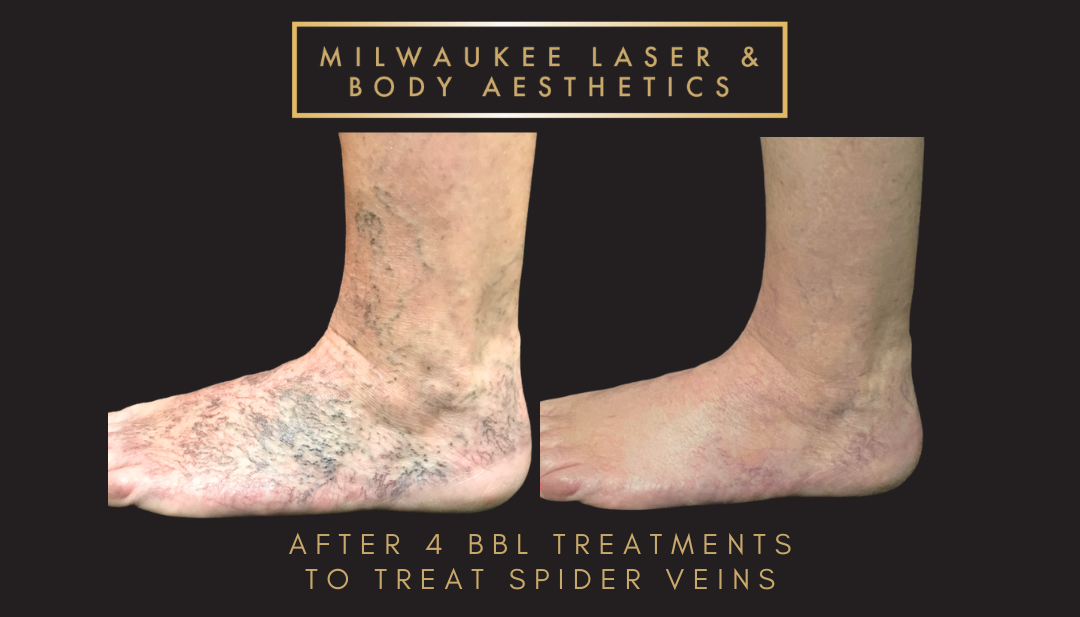 Mequon Vein Treatment Plan & 4 MLB Treatments before and after image