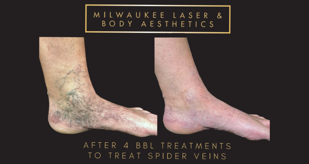 Mequon Vein Treatment Plan & 4 MLB Treatments before and after image