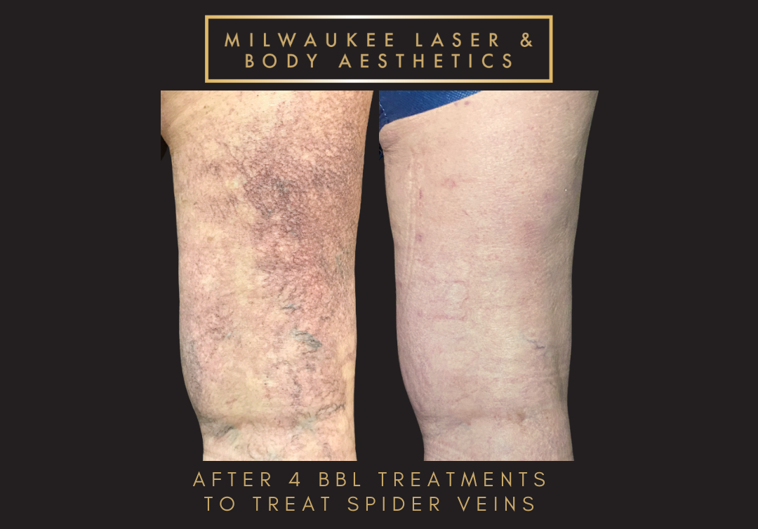 Mequon Vein Treatment Plan & 4 MLB Treatments before and after image