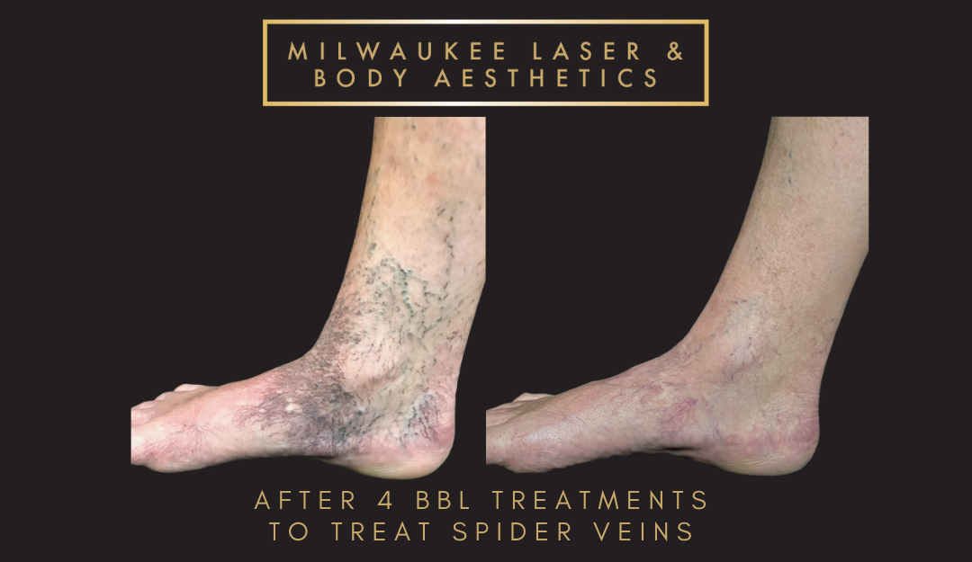 Mequon Vein Treatment Plan & 4 MLB Treatments before and after image