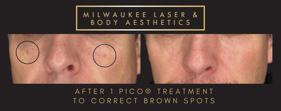 Browns - 1 Treatment before and after image