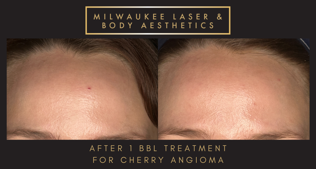 Reds/Rosacea - 1 Treatment Forhead before and after image