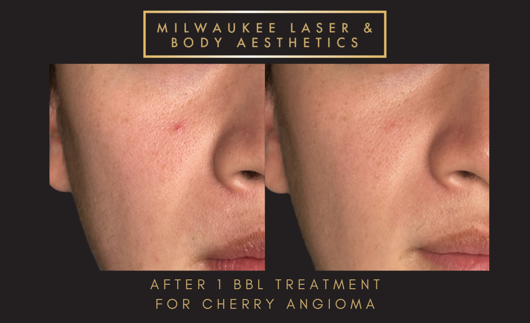 Reds/Rosacea - 1 Treatment before and after image