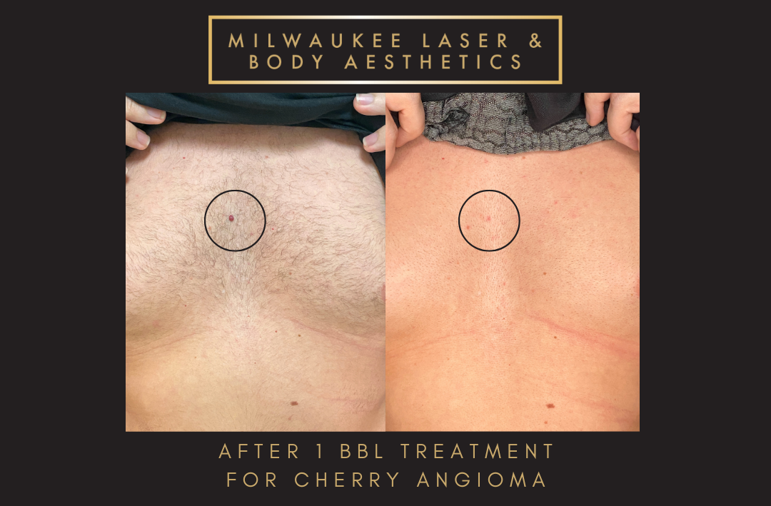 Reds/Rosacea - 1 Treatment Chest before and after image