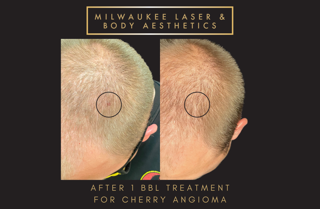 Reds/Rosacea - 1 Treatment Head before and after image