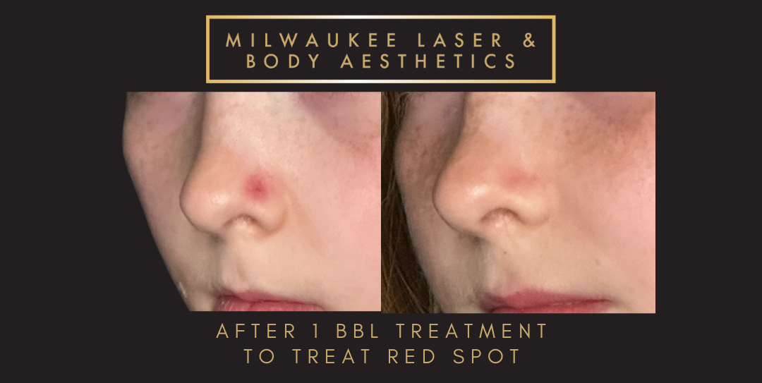 Reds/Rosacea - 1 Treatment before and after image