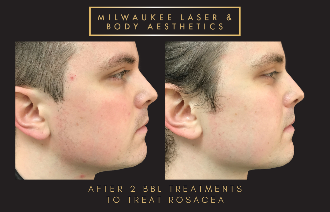 Reds / Rosacea - 2 Treatments before and after image