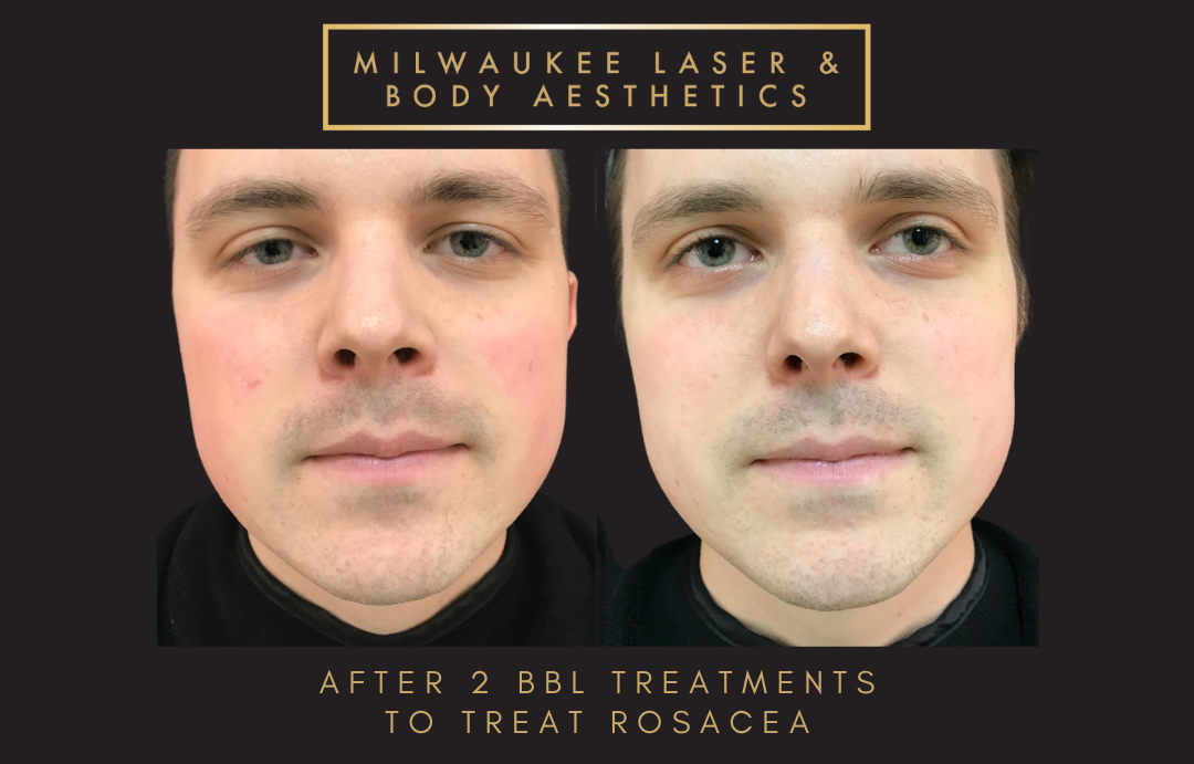 Reds / Rosacea - 2 Treatments before and after image