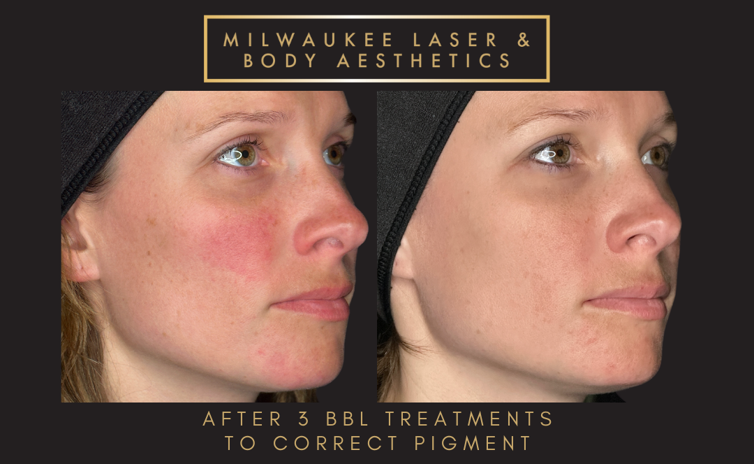 Rosacea - 3 Treatments before and after image