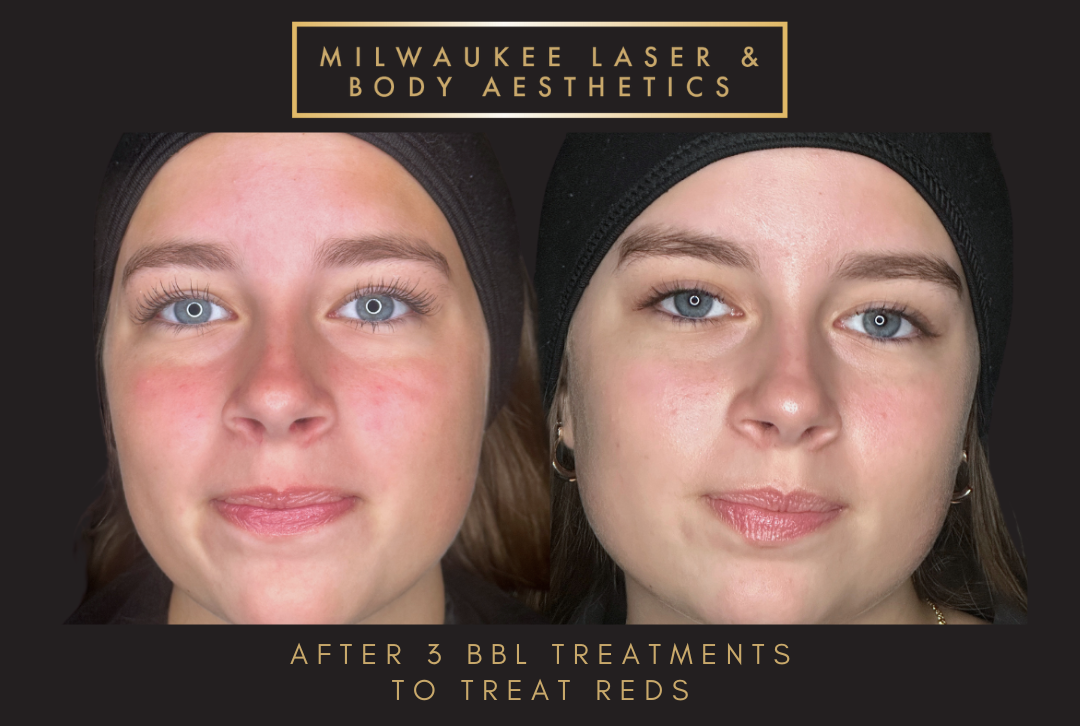 Reds/Rosacea - 3 Treatments before and after image