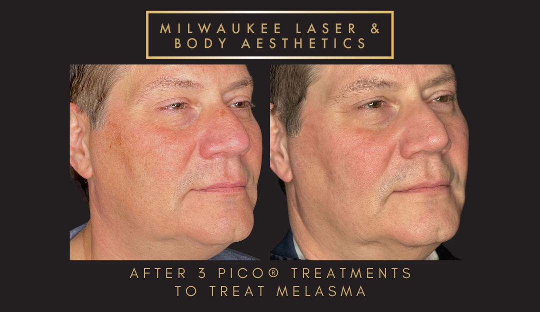 Melasma - 3 Treatments before and after image