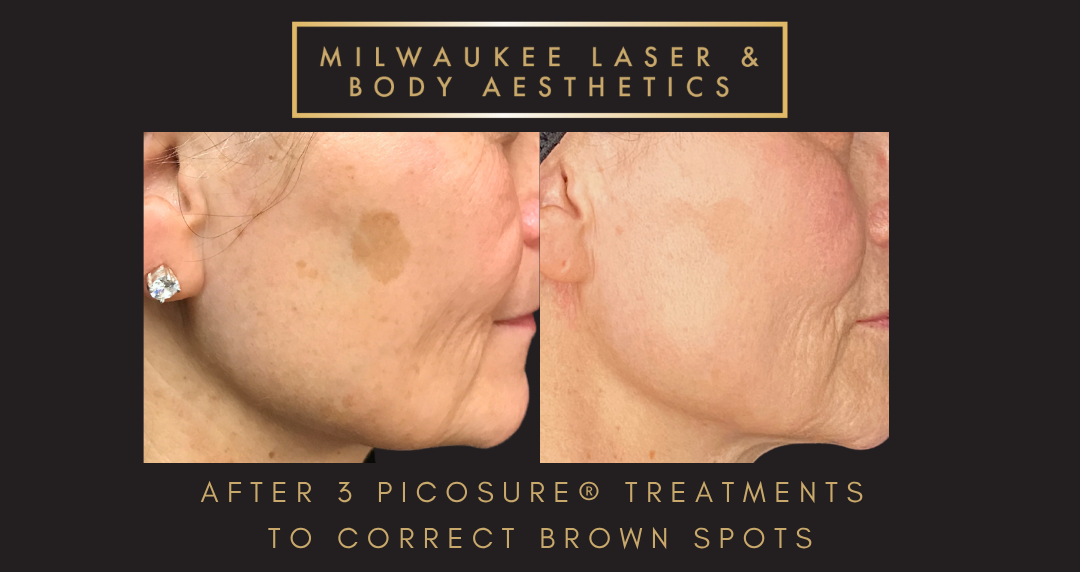 Browns - 2 Treatments before and after image