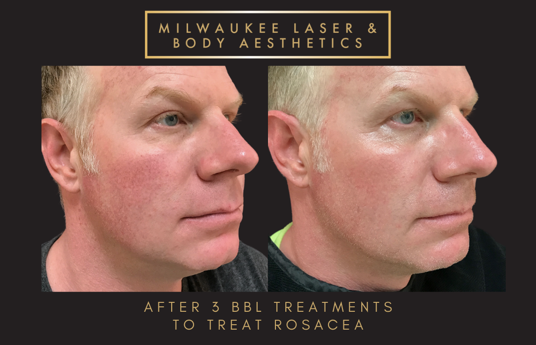 Rosacea Treatment before and after image