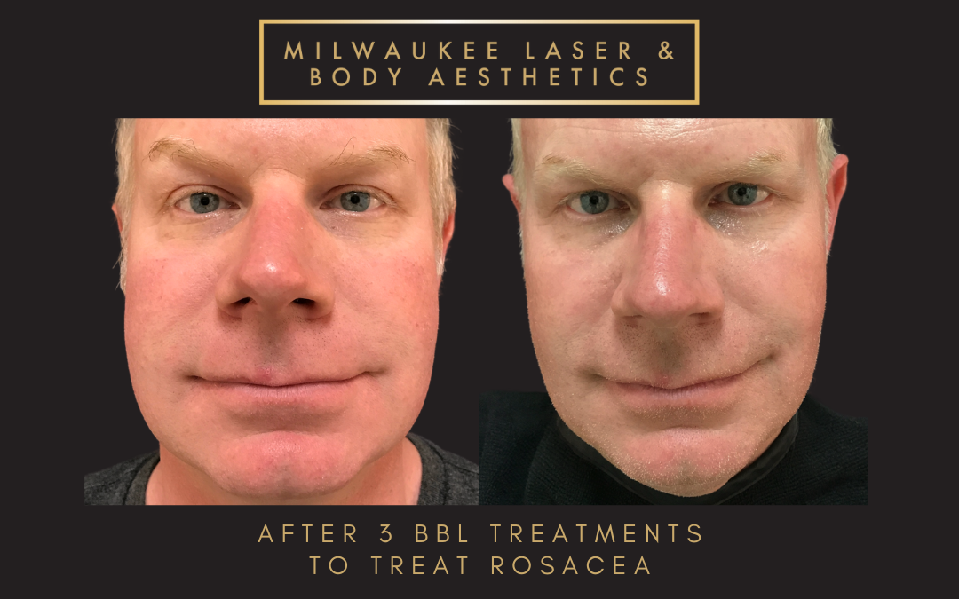 Rosacea Treatment before and after image