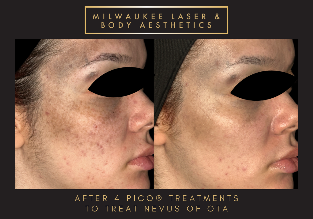 Nevus of ota - 4 Treatments before and after image