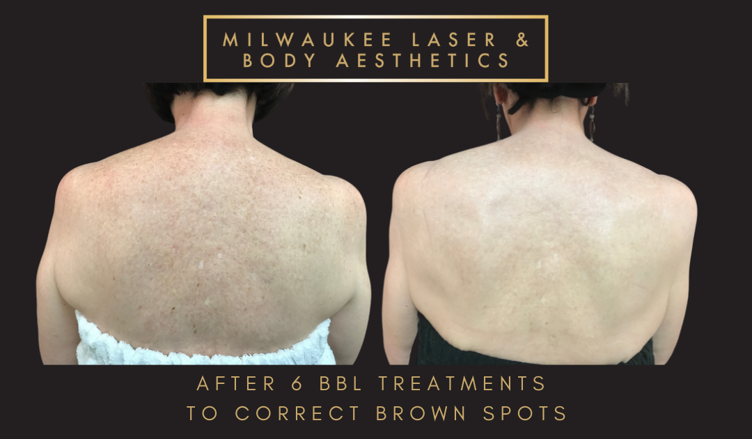 Browns - 6 Treatments before and after image