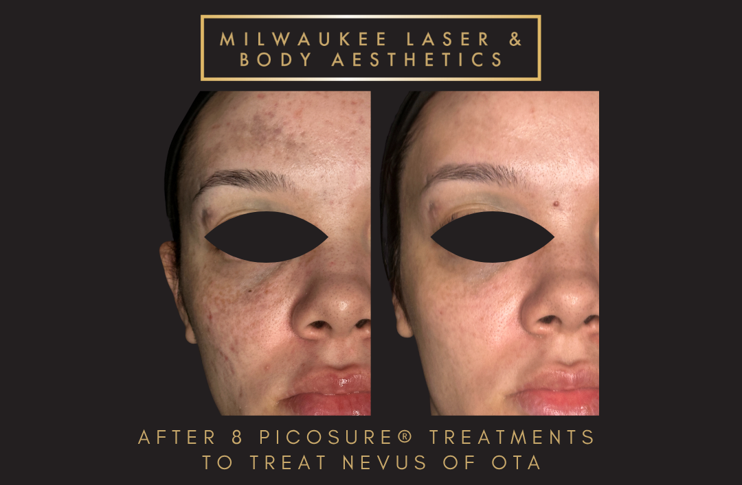 Nevus of ota - 8 Treatments before and after image