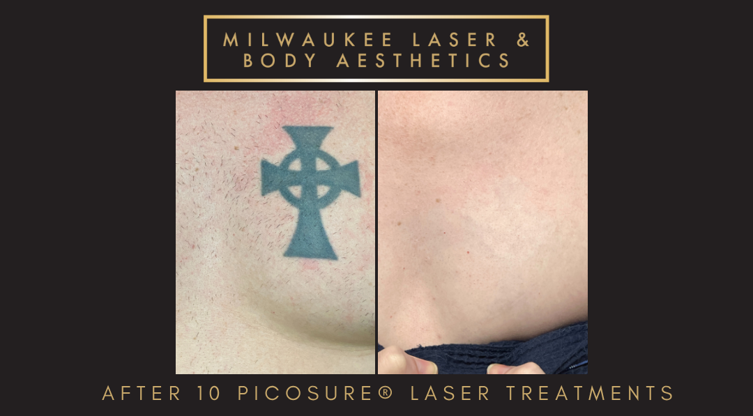 Tattoo Removal - 10 Treatments before and after image