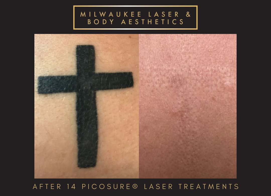 Tattoo Removal - 14 Treatments before and after image