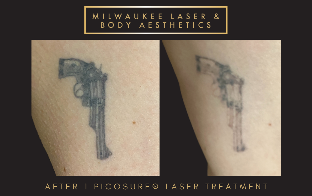 Tattoo Removal - 1 Treatment before and after image