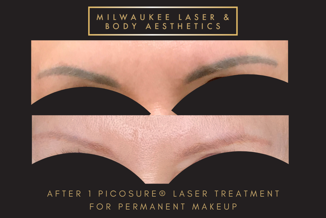 Permanent Makeup Removal - 1 Treatment before and after image