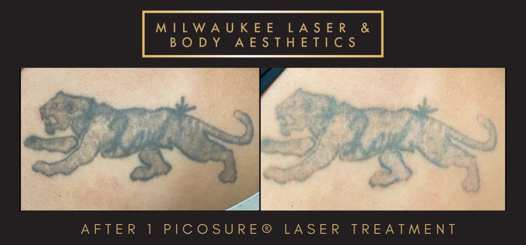 Tattoo Removal - 1 Treatment before and after image