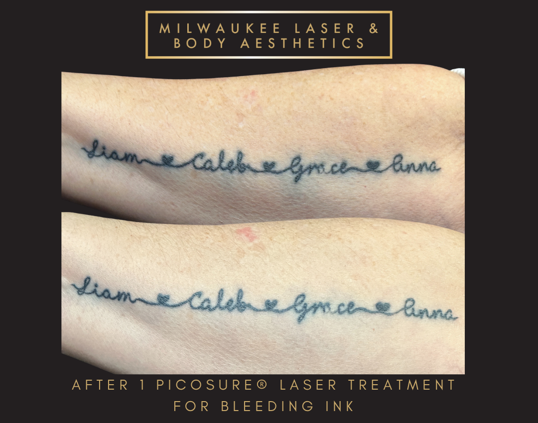 Tattoo Removal - 1 Treatment before and after image