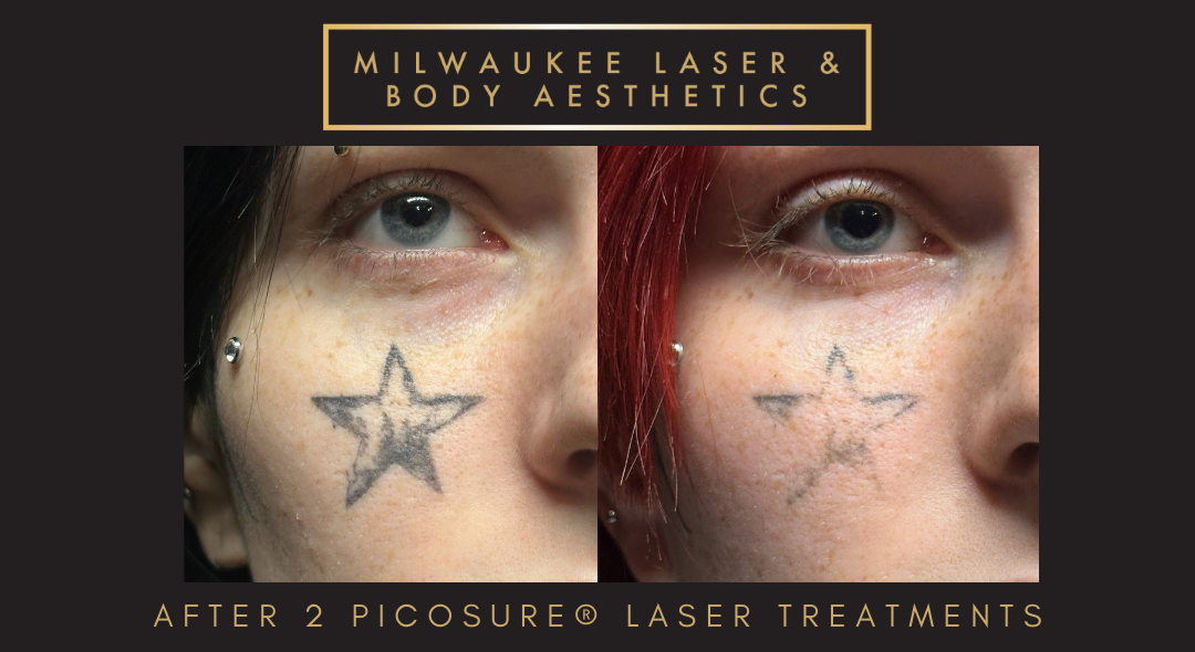 Tattoo Removal - 2 Treatments before and after image