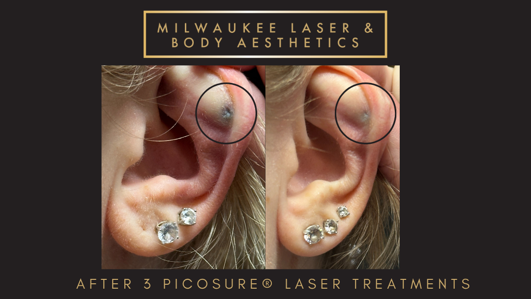 Tattoo Removal - 3 Treatments before and after image