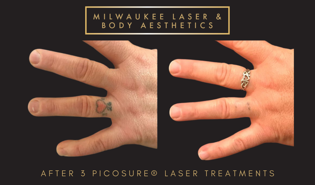 Tattoo Removal - 3 Treatments before and after image