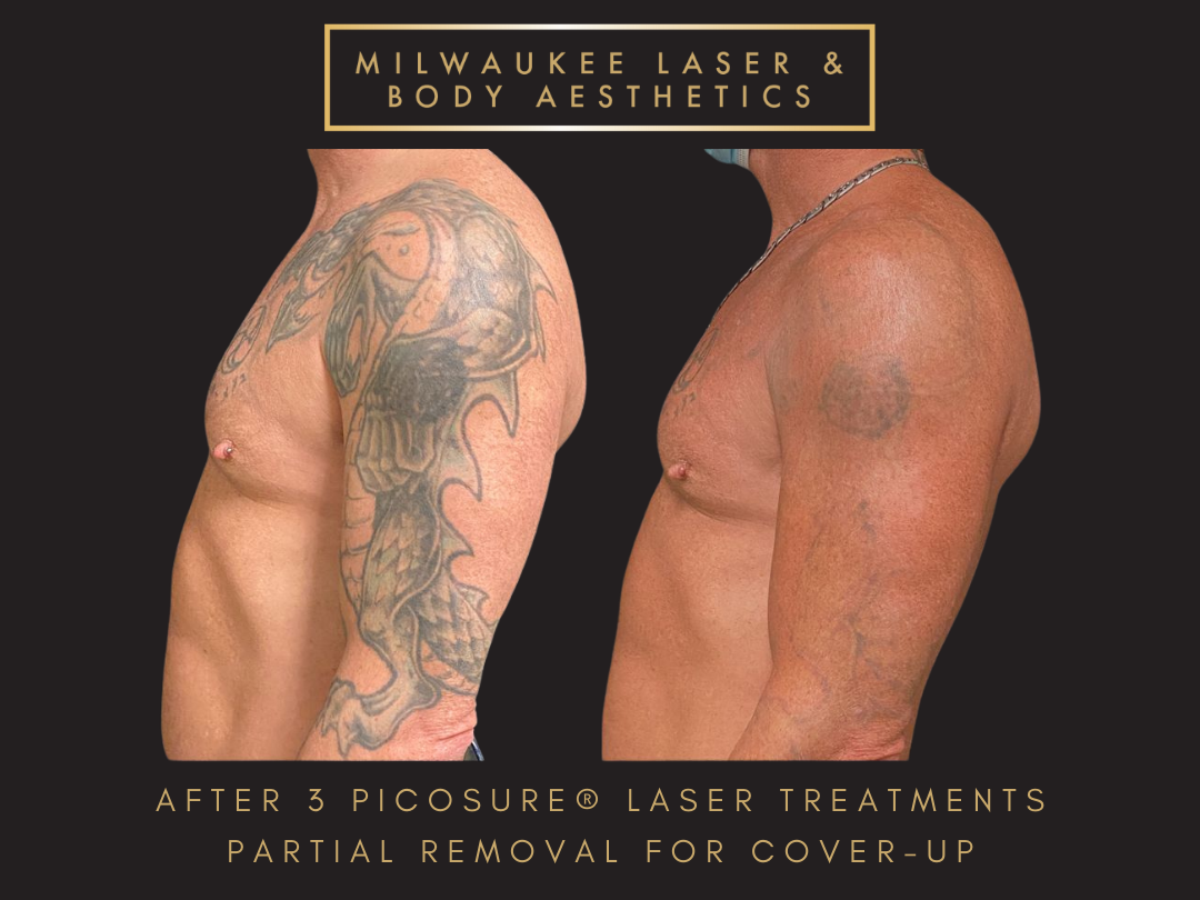 Partial Tattoo Removal for Cover-up - 3 Treatments before and after image