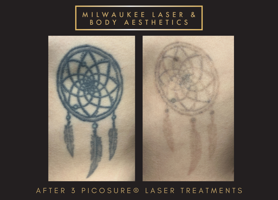 Tattoo Removal - 3 Treatments before and after image
