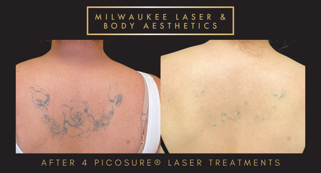 Tattoo Removal - 4 Treatments before and after image
