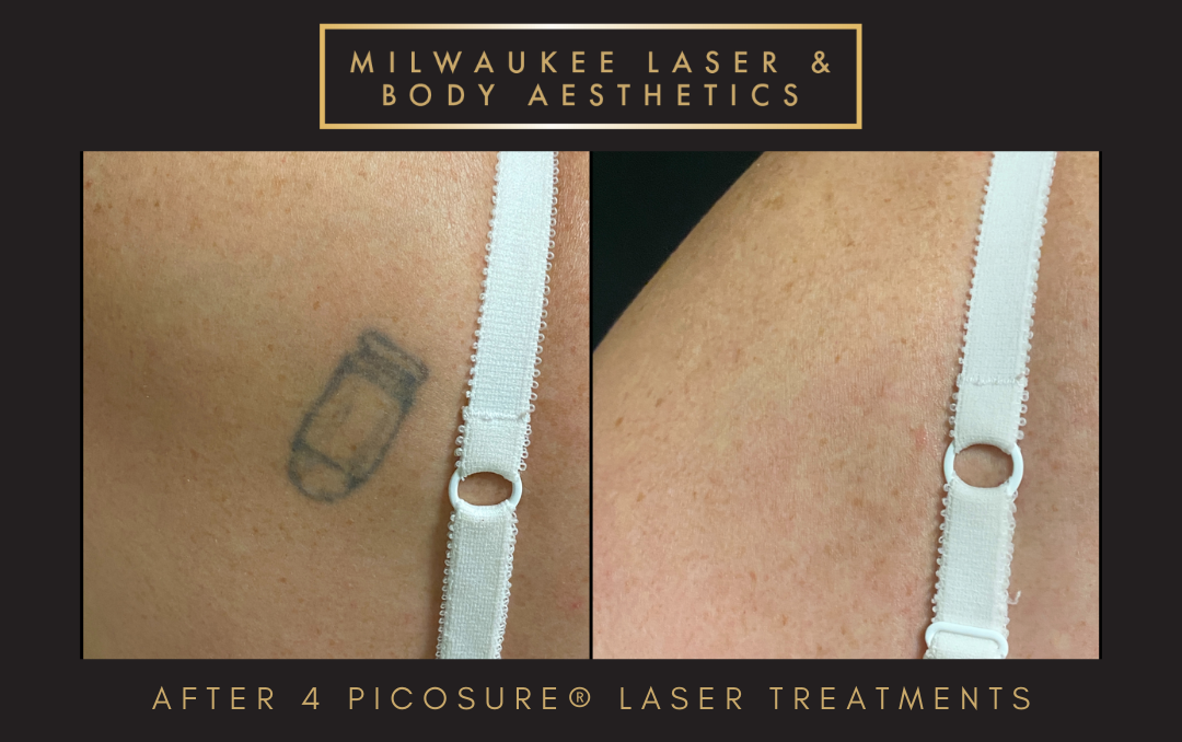 Tattoo Removal - 4 Treatments before and after image