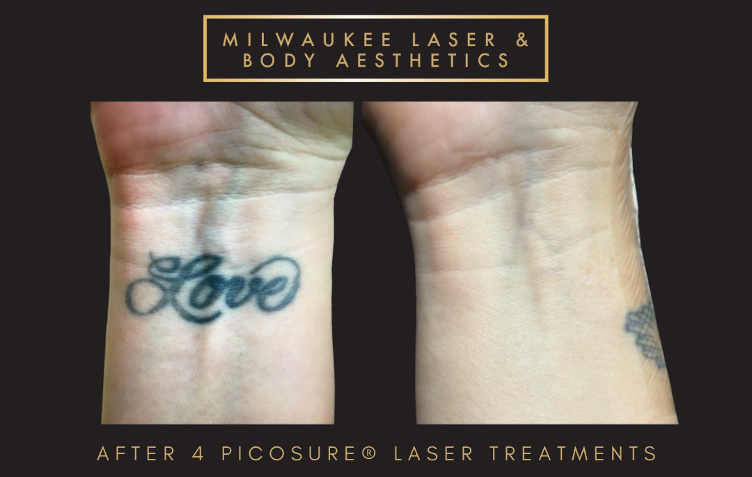 Tattoo Removal - 4 Treatments before and after image