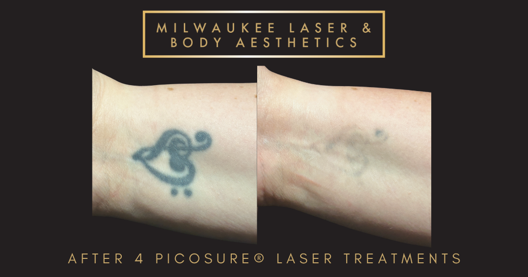 Tattoo Removal - 4 Treatments before and after image