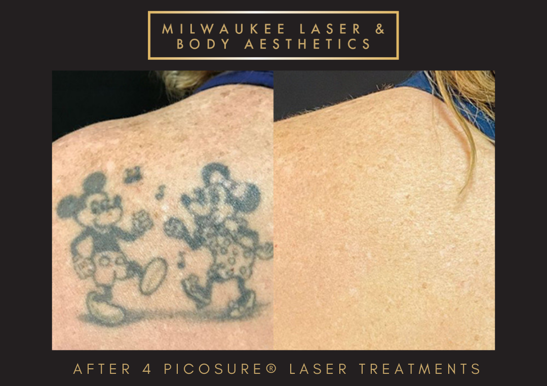 Tattoo Removal - 4 Treatments before and after image