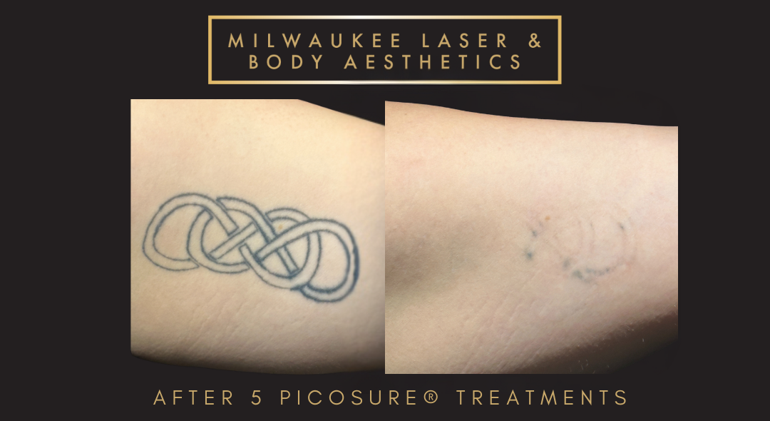 Tattoo Removal - 5 Treatments before and after image