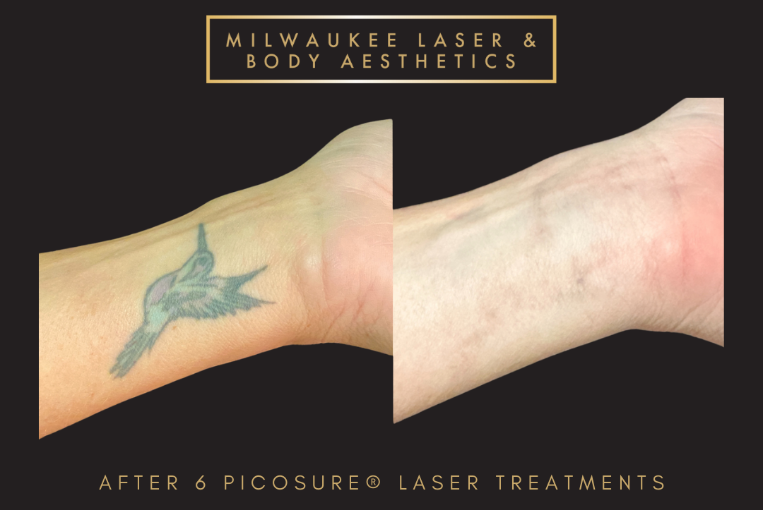 Tattoo Removal - 6 Treatments before and after image